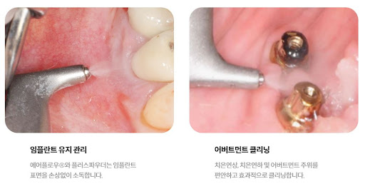 임플란트와 치아교정 전문 불당본점 서울비디치과의원에서의 우수한 치료 안내
